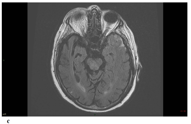 Convexity Subarachnoid Hemorrhage, Pseudomonas Aeruginosa (PA) Infective Endocarditis and Left Atrial Appendage Occluder (LAAO) Device Infection. A Case Report.