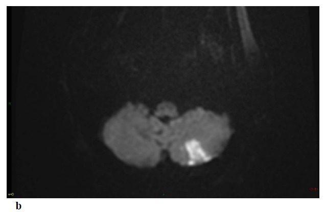 Convexity Subarachnoid Hemorrhage, Pseudomonas Aeruginosa (PA) Infective Endocarditis and Left Atrial Appendage Occluder (LAAO) Device Infection. A Case Report.