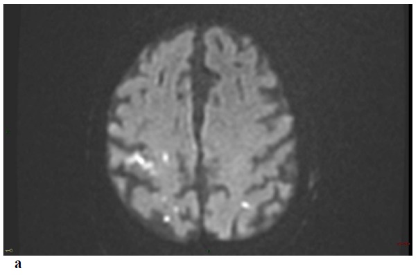 Convexity Subarachnoid Hemorrhage, Pseudomonas Aeruginosa (PA) Infective Endocarditis and Left Atrial Appendage Occluder (LAAO) Device Infection. A Case Report.