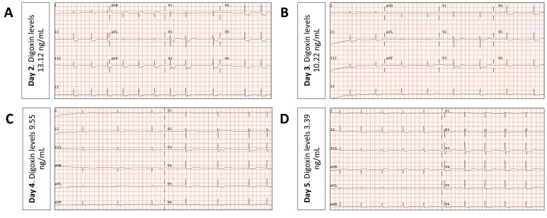 Electrocardiographic Changes After Suicidal Digoxin Intoxication in a Healthy Woman.