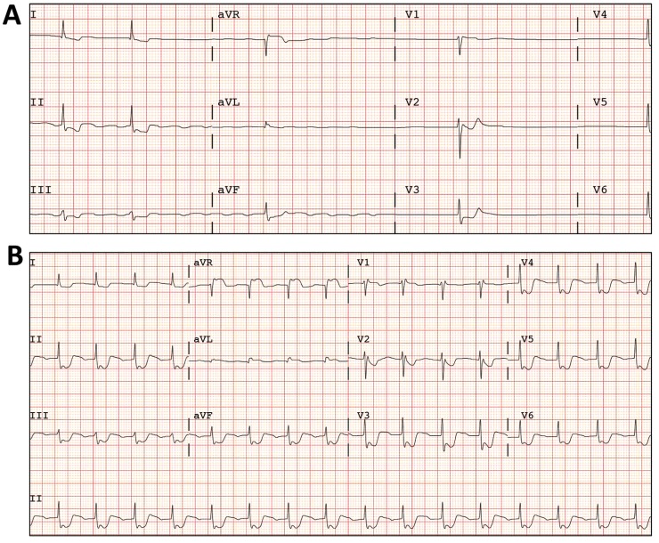 Electrocardiographic Changes After Suicidal Digoxin Intoxication in a Healthy Woman.