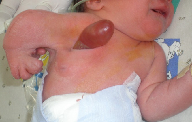 Thoracoschisis associated with Limb Body Wall Complex.