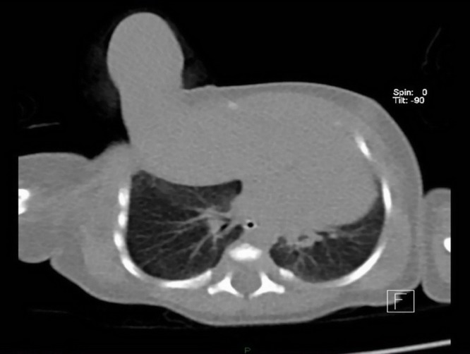 Thoracoschisis associated with Limb Body Wall Complex.