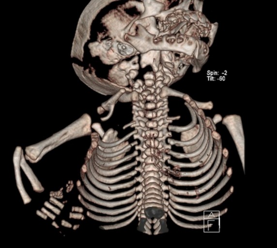 Thoracoschisis associated with Limb Body Wall Complex.
