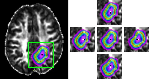 Image-driven modeling of the proliferation and necrosis of glioblastoma multiforme.