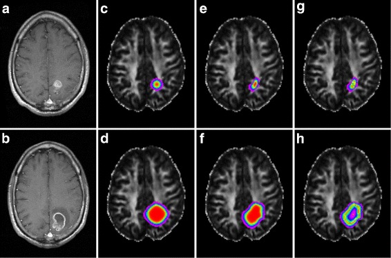 Image-driven modeling of the proliferation and necrosis of glioblastoma multiforme.