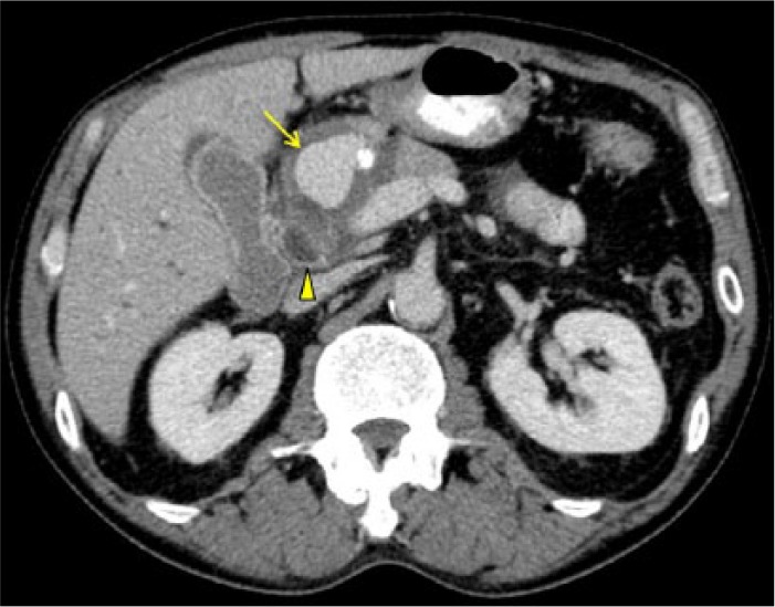 The Aftermath of a Hepatic Artery Aneurysm-A Rare Etiology of Biliary Obstruction!