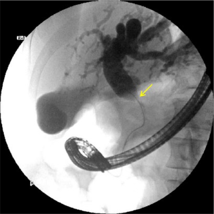 The Aftermath of a Hepatic Artery Aneurysm-A Rare Etiology of Biliary Obstruction!