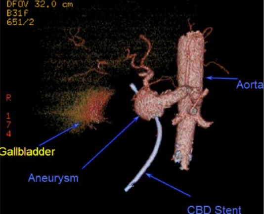 The Aftermath of a Hepatic Artery Aneurysm-A Rare Etiology of Biliary Obstruction!