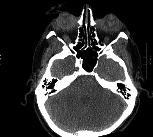 A Case of Attempted Bilateral Self-Enucleation in a Patient with Bipolar Disorder.