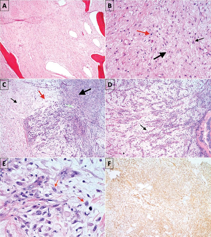 Myxofibrosarcoma of the maxillary sinus.