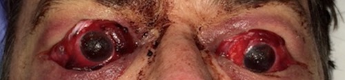 A Case of Attempted Bilateral Self-Enucleation in a Patient with Bipolar Disorder.