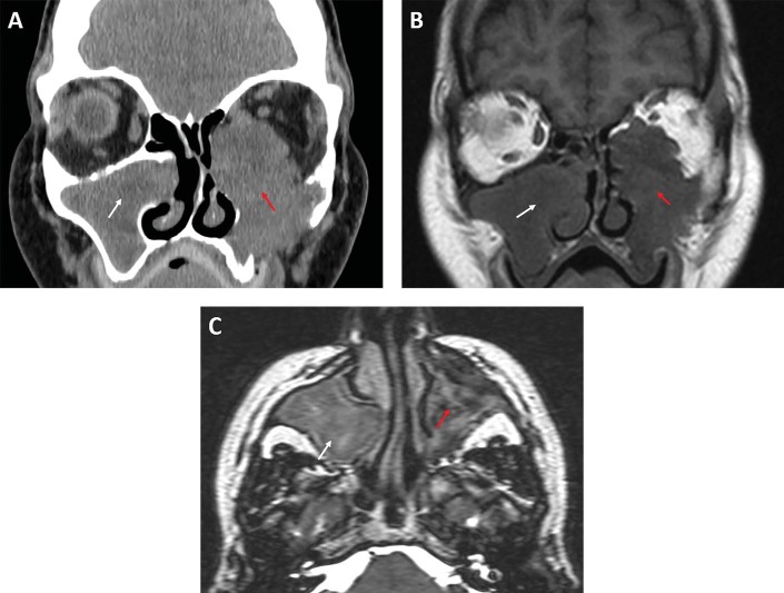 Myxofibrosarcoma of the maxillary sinus.