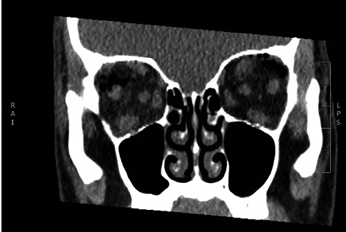 A Case of Attempted Bilateral Self-Enucleation in a Patient with Bipolar Disorder.