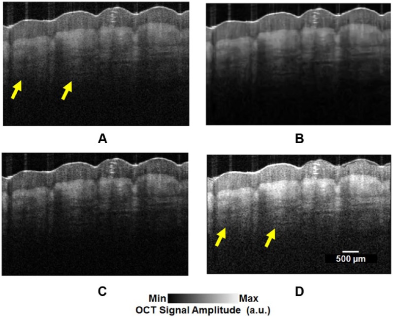 Optical Coherence Tomography Technology and Quality Improvement Methods for Optical Coherence Tomography Images of Skin: A Short Review.