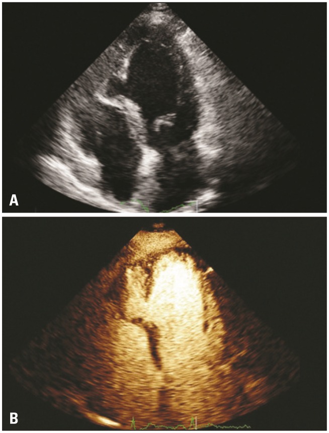 Bifid Cardiac Apex in an Old Woman.