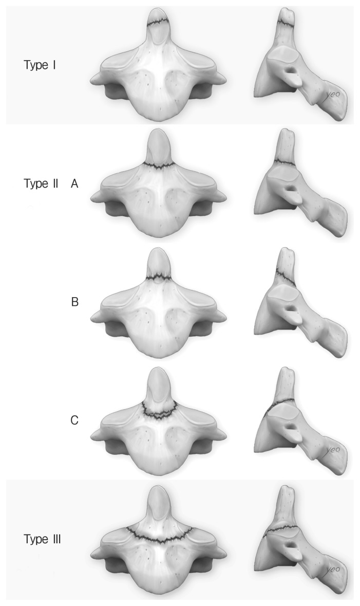 Clinical Results of Odontoid Fractures according to a Modified, Treatment-Oriented Classification.