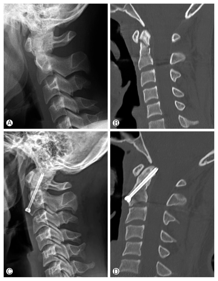 Clinical Results of Odontoid Fractures according to a Modified, Treatment-Oriented Classification.