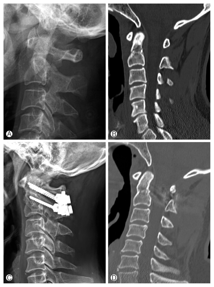 Clinical Results of Odontoid Fractures according to a Modified, Treatment-Oriented Classification.