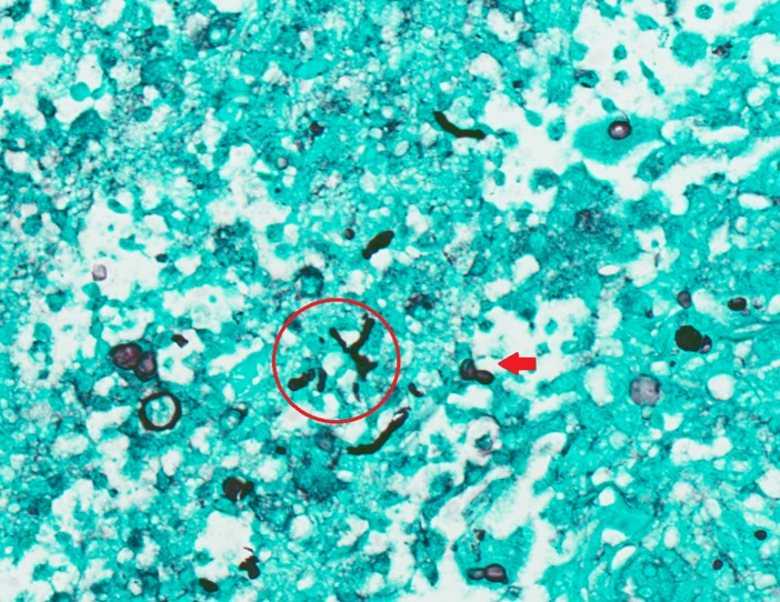 Cutaneous fungal infection in an immunocompromised host.