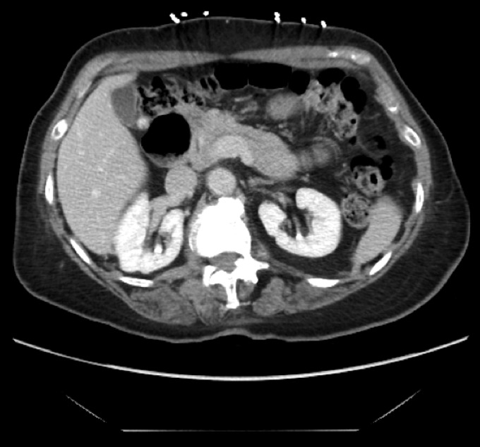 Central Pancreatectomy with Pancreaticojejunostomy for an Insulinoma: A Case Report with Literature Review.