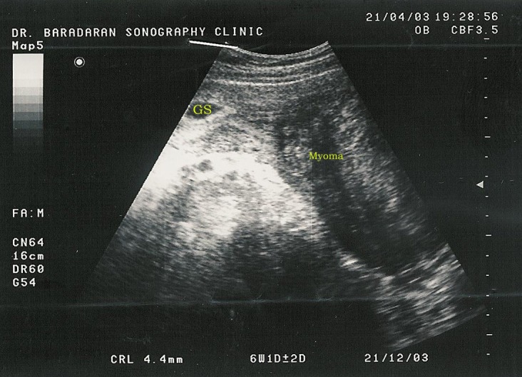 Successful Myomectomy during Cesarean Section: Case Report & Literature Review.