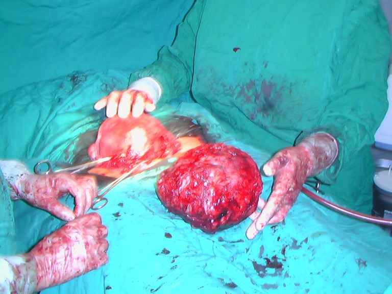 Successful Myomectomy during Cesarean Section: Case Report & Literature Review.