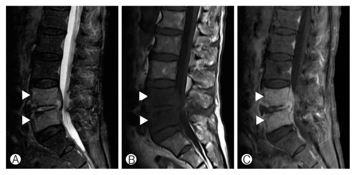 Pyogenic Vertebral Osteomyelitis: Clinical Features, Diagnosis, and Treatment.