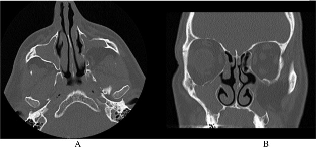 Bilateral silent sinus syndrome: A rare case and review of literature.