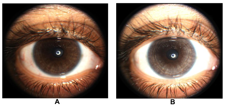 Moxifloxacin Concentration and Proteomic Analysis of Aqueous Humor in Human Uveitis Associated with Oral Moxifloxacin Therapy.