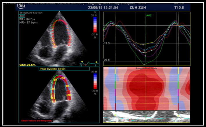 Value of global longitudinal strain by two dimensional speckle tracking echocardiography in predicting coronary artery disease severity