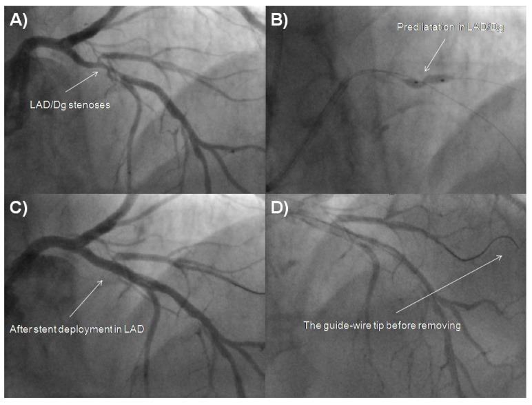 Coronary Perforation of Distal Diagonal Branch Followed by Prolonged Recurrent Cardiac Tamponade Finally Resolved with Pericardiotomy - the Potential Risk of Hydrophilic Guide-Wires.