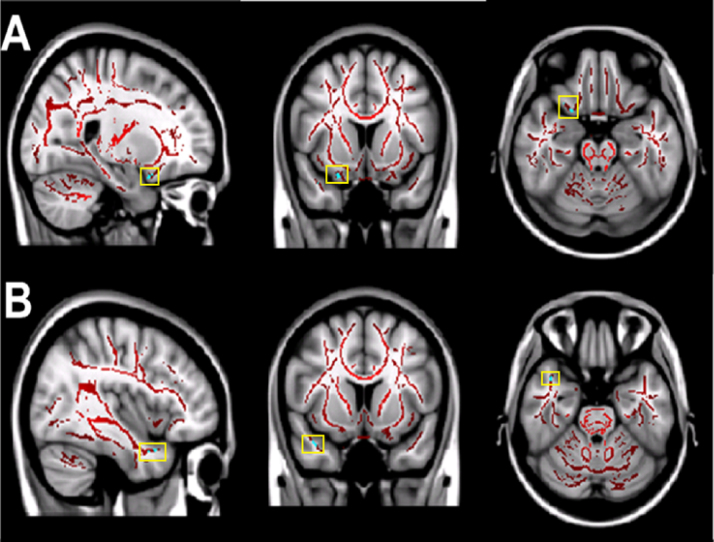 Habitual sleep durations and subjective sleep quality predict white matter differences in the human brain