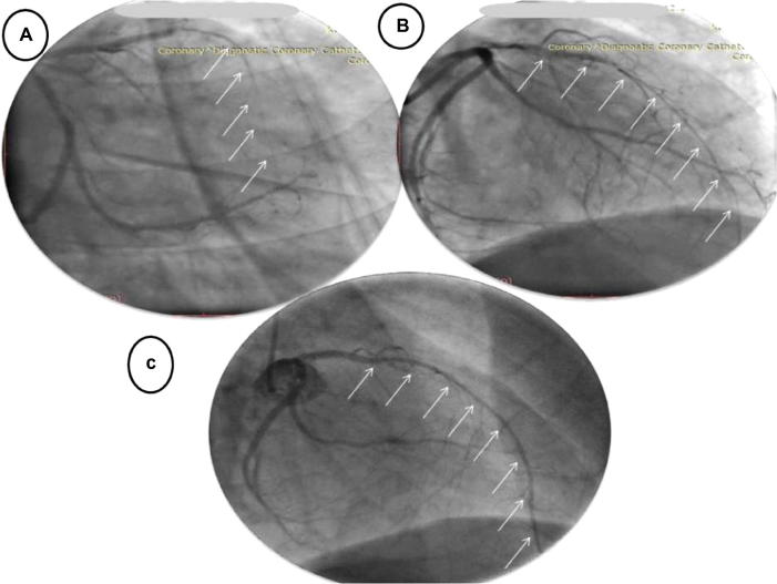 Pattern of vascular remodeling of distal reference segment after recanalization of chronic total occlusion, long-term angiographic follow-up