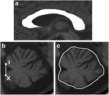 Stratification of disease progression in a broad spectrum of degenerative cerebellar ataxias with a clustering method using MRI-based atrophy rates of brain structures.