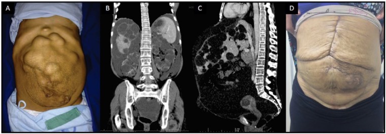 Functional Budd-Chiari Syndrome Associated With Severe Polycystic Liver Disease.