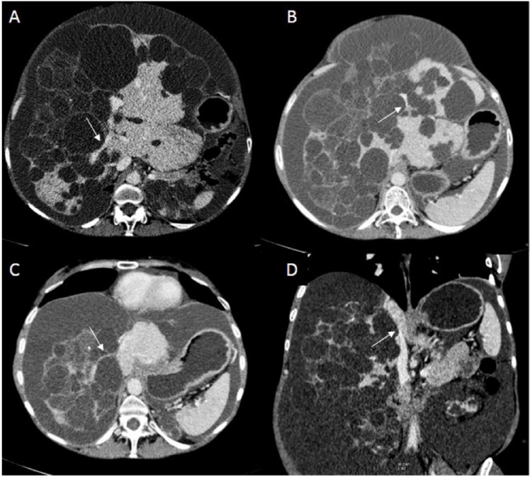 Functional Budd-Chiari Syndrome Associated With Severe Polycystic Liver Disease.