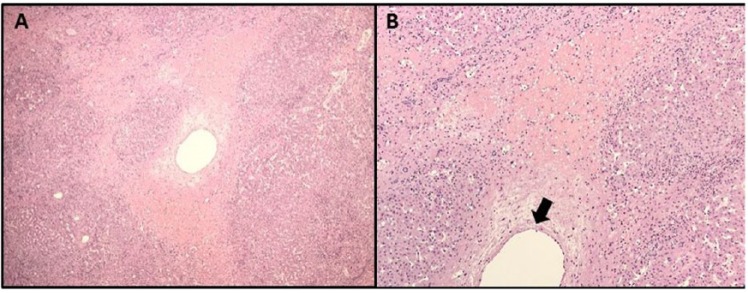 Functional Budd-Chiari Syndrome Associated With Severe Polycystic Liver Disease.