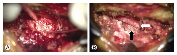 Tophaceous Gout in the Lumbar Spinal Canal Mimicking Epidural Spinal Tumor.