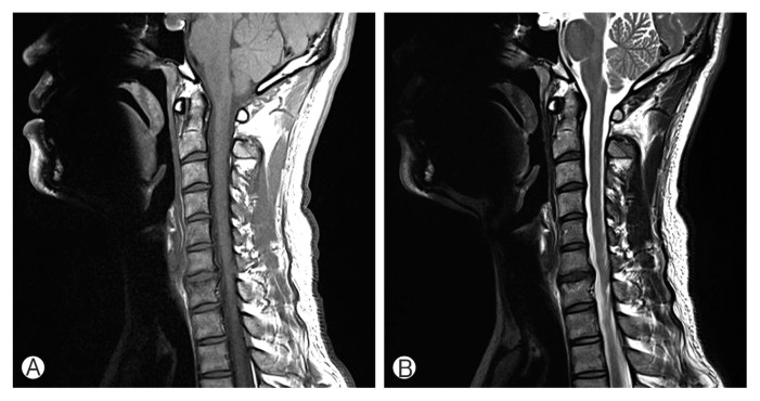 Effect of Modic Changes in Cervical Degenerative Disease.