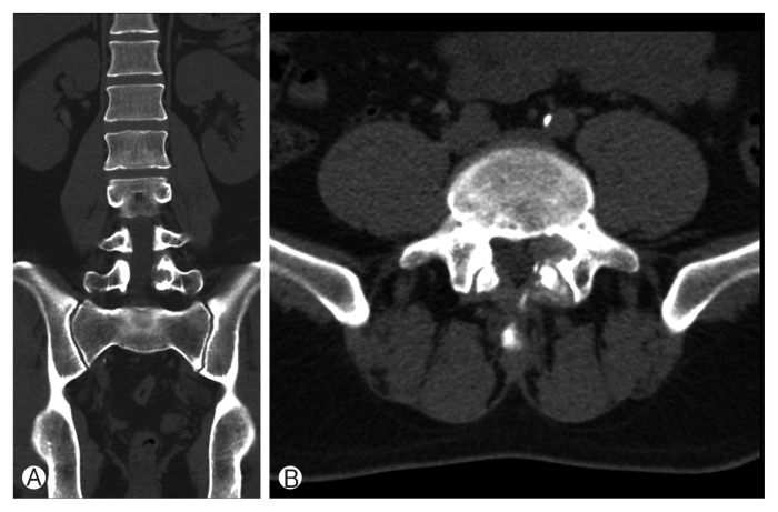 Tophaceous Gout in the Lumbar Spinal Canal Mimicking Epidural Spinal Tumor.