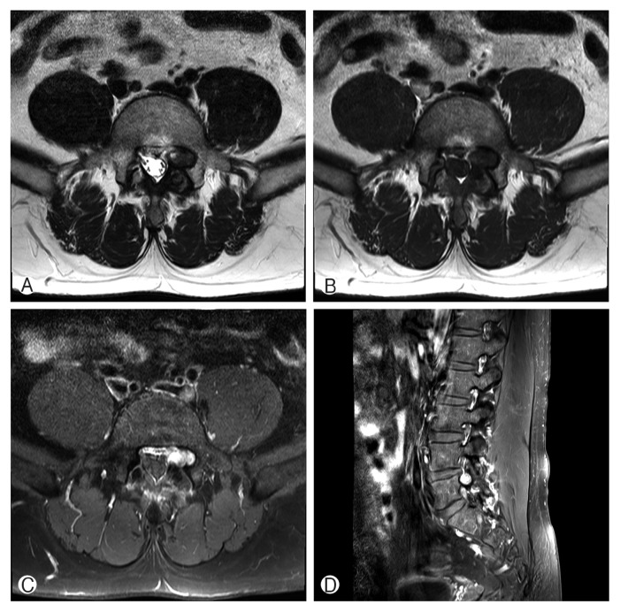 Tophaceous Gout in the Lumbar Spinal Canal Mimicking Epidural Spinal Tumor.