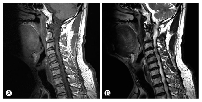 Effect of Modic Changes in Cervical Degenerative Disease.