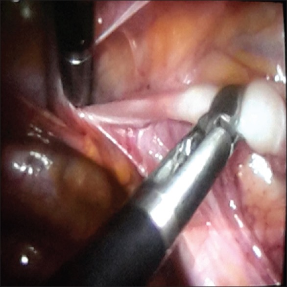 Early Experience with Laparoscopic Management of Nonpalpable Undescended Testes.