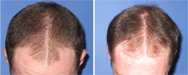 Hair follicle growth by stromal vascular fraction-enhanced adipose transplantation in baldness.