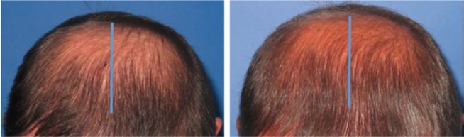 Hair follicle growth by stromal vascular fraction-enhanced adipose transplantation in baldness.