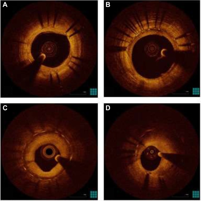 Coronary stents and vascular response to implantation: literature review.