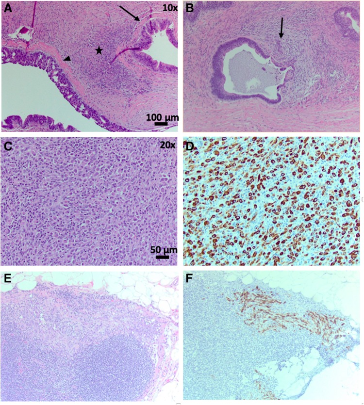 Anaplastic Pancreatic Carcinoma Arising Within a Mucinous Cystic Neoplasm of the Pancreas: A Case Report and a Brief Review of the Literature.