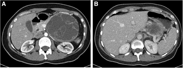 Anaplastic Pancreatic Carcinoma Arising Within a Mucinous Cystic Neoplasm of the Pancreas: A Case Report and a Brief Review of the Literature.