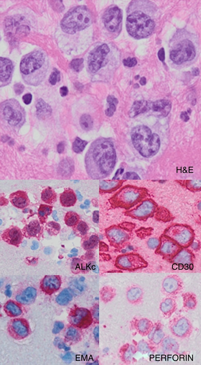 Small cell variant of anaplastic large cell lymphoma with leukemic presentation: a diagnostic challenge